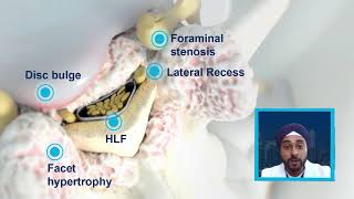 NYNJ Abstract  Mild Treatment Outcomes in the Presence of Foraminal Narrowing [upl. by Enautna]