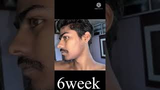 Kirkland minoxidil beard journey 2 months transformation  Beard solution shorts india [upl. by Suedama]