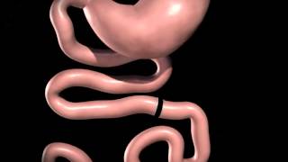 Gastric Bypass  how it works  Phoenix Health [upl. by Dafodil]