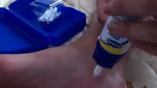 Dr Scholls Dual Action Freeze away wart remover how to for large warts [upl. by Aronoh]