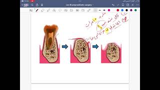 Preprosthetic Surgery lec8 stage5 [upl. by Agace]