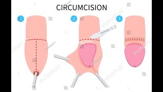 Circumcision Surgery  Step by Step Procedure  Circumcision Animation [upl. by Tabbie878]