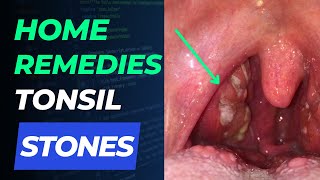 7 Home Remedies For Tonsil Stones [upl. by Clyte]