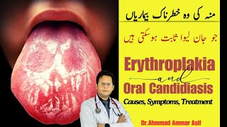 What Is Erythroplakia amp Oral Candidiasis  Causes Symptoms Treatment [upl. by Gawen237]