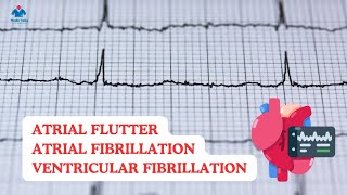 Atrial Flutter  Atrial Fibrillation  Ventricular Fibrillation  Circus Rythm  Dr Krunal Dabhi [upl. by Venable]