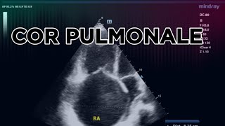 COR PULMONALE 2D ECHO [upl. by Eniamrahs]