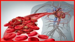 Embolie pulmonaire  symptômes et traitement [upl. by Chandal]