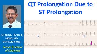 QT Prolongation Due to ST Prolongation [upl. by Yaj303]