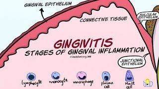 Gingivitis Stages of Gingival Inflammation [upl. by Ytsirhc]