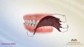 Orthodontic Retainers Hawley Clear and Permanent [upl. by Meyeroff]