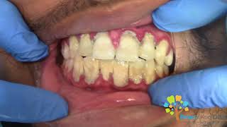 Dental Cleaning to remove heavy tartar🦷 【Young Male first cleaning】 [upl. by Adelaide]