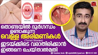 തൊണ്ടയിൽ നിന്നും ദുർഗന്ധമുള്ള വെള്ള അരിമണികൾ Tonsil Stones  വരാതിരിക്കാൻ ഇങ്ങനെ ചെയ്‌താൽ മതി [upl. by Anilorac]