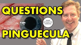 PINGUECULA QUESTIONS ANSWERED by YouTube Eye Doctor amp Optometrist yellow spot on eye explained [upl. by Ljoka]