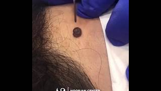 mole removal with Plasmage ®  by noorjan center [upl. by Paryavi]