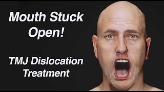 Mouth Stuck Open TMJ Dislocation Treatment Open Lockjaw [upl. by Nidnarb138]