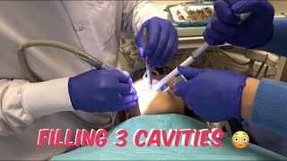 FILLING 3 CAVITIES [upl. by Proudman308]