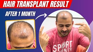 My Hair Transplant 1 Month Update  Shedding Phase After Hair Transplant  Hairmate Clinic Pune [upl. by Odlaniger]