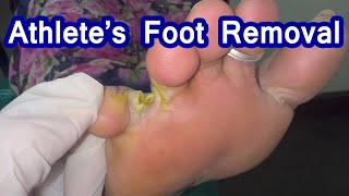 Athletes foot Removal  Fungal skin infection athletefoot [upl. by Hauck925]