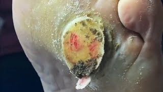 Pedicure video22，vertical plantaris，plantar wart [upl. by Sgninnej741]