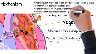 Infective Endocarditis  simply explained Symptoms signs causes [upl. by Kos]