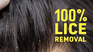 Get Rid Of Lice COMPLETELY  Safe amp Natural Home Remedies For Lice amp Nits [upl. by Aetnuahs]