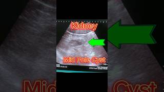 Kidney Cysts on Ultrasound  how to diagnose simple Renal Cyst shorts [upl. by Ninos]