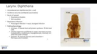 Larynx Diphtheria Gross pathology [upl. by Wain991]