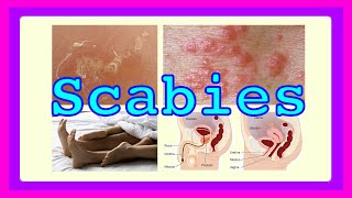 scabies [upl. by Notsehc]