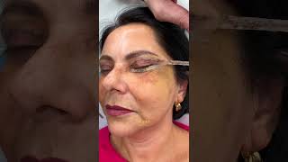 Video Before amp After 7 zile după BLEFAROPLASTIE totală la Clinica Dr Levy Like amp Subscribe [upl. by Sayer]