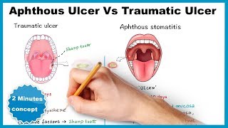 Aphthous ulcerstomatitis Vs Traumatic ulcer [upl. by Ekud]