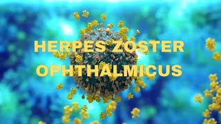 Herpes zoster ophthalmicus  OPHTHALMOLOGY  NEETPG  virus  keratitis [upl. by Mannes743]