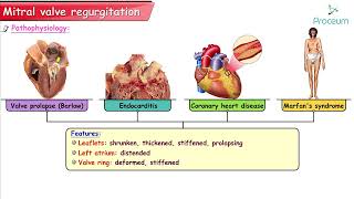 Mitral Regurgitation  Etiology Pathophysiology Clinical findings Diagnosis and Treatment  USMLE [upl. by Arah]