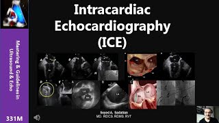 Intracardiac Echocardiography ICE [upl. by Micro]