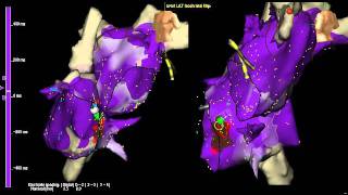 AV node reentry tachycardia atrial activation with 3D mapping [upl. by Anavlis]