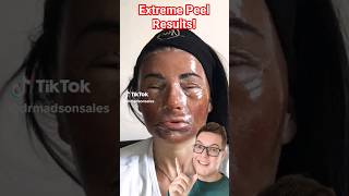 THIS IS CRAZY  Extreme Phenol Peel For Acne Scarring [upl. by Brosy]