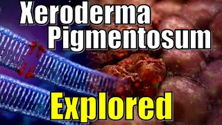 quot Vampire Syndrome quot Xeroderma Pigmentosum DNA Damaged Explained  Effects of UV Radiation on Genes [upl. by Nehte]