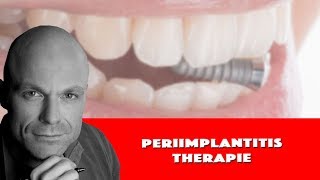 therapie einer zahnimplantat entzündung  periimplantitis therapie [upl. by Curran46]