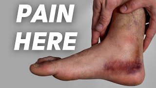 Deltoid Ligament Sprain EXERCISES Causes Symptoms Diagnosis and Treatment [upl. by Morry]