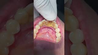 Teeth mobility dentistteeth dentist dentaltreatment [upl. by Asirak151]