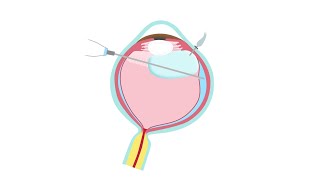 Retinal Detachment Treatment—Pars Plana Vitrectomy [upl. by Kolk]