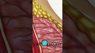 PreOp® Incisional Breast Biopsy What to Expect amp How to Prepare 🌟 preop shorts health 💡 [upl. by Kevon44]