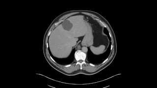 Esophagus  Leiomyoma distal esophagus [upl. by Cad]