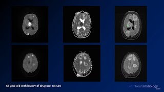 Intracranial infections  3  Focal Infections [upl. by Dera]