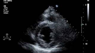 Hypokinesis Mitral Regurgitation Aortic Insufficiency [upl. by Bohrer901]