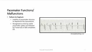 Pacemaker Overview [upl. by Spanjian]