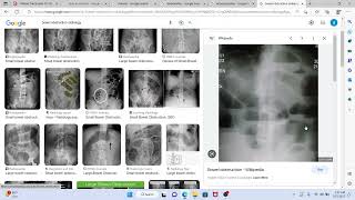 Surgery 4 MTB Cholelithiasis cholangitis obstructive jaundice [upl. by Veronika]