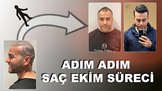 Adım Adım Saç Ekimi I FATMA DURSUN [upl. by Lenej]