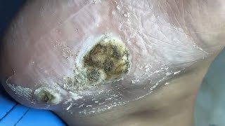 Removing dead Skin of large size Warts  Removing dead skin affected by Fungus on heel  pedicure [upl. by Yanarp]