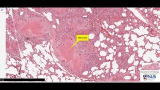 Lung miliary TB microscopy  Talking slide [upl. by Nowed]