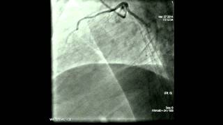 Coronary angiography procedure [upl. by Liane]